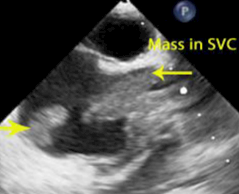 Superior vena cava and tricuspid valve tumoral thrombosis in a 54-year-old female with metastatic colorectal adenocarcinoma